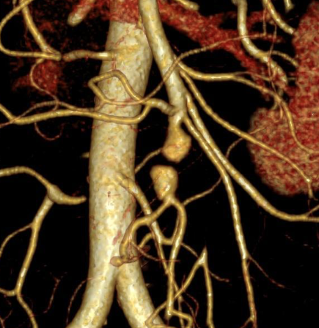 Pseudoaneurisma micótico AMS